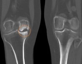 Right knee arthrosis