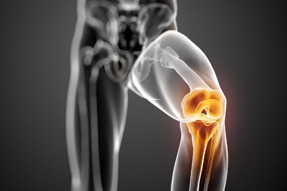 Artrosis of knee joint