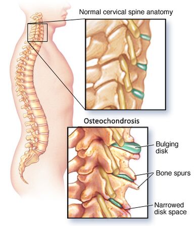 Cervical osteocondrosis