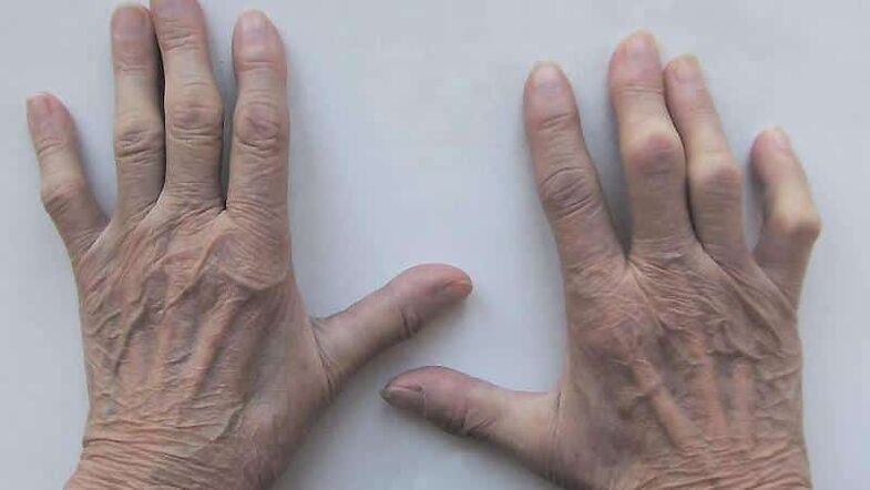Treatment of pain in the joints of fingers