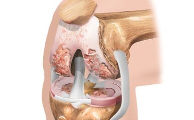 Artrosis of knee joint