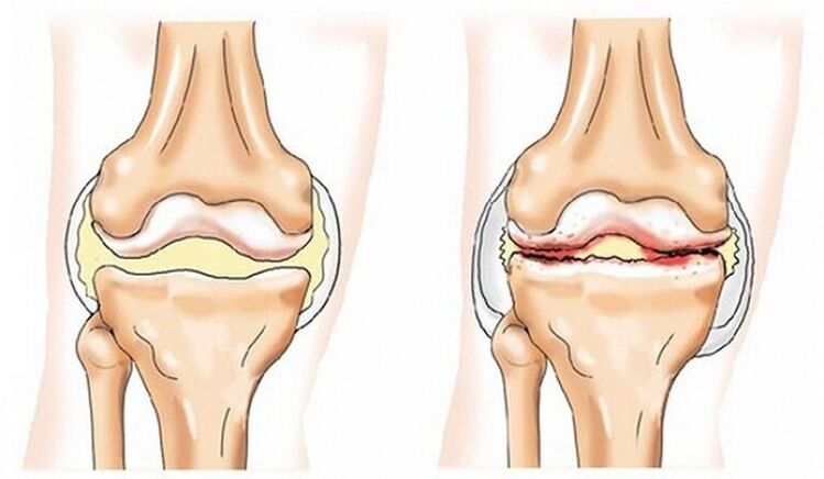 Jointly affected by healthy combination and arthrosis