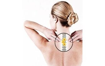 Cervical osteochondrosis in a woman