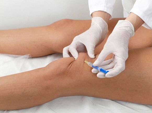 Fine injection for knee arthrosis