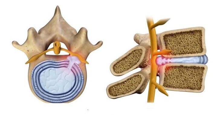 Intervertebral disc herniation - protrusion of the disc core into the spinal canal